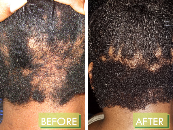 HOPE RENEWED Scalp & Hair Treatment